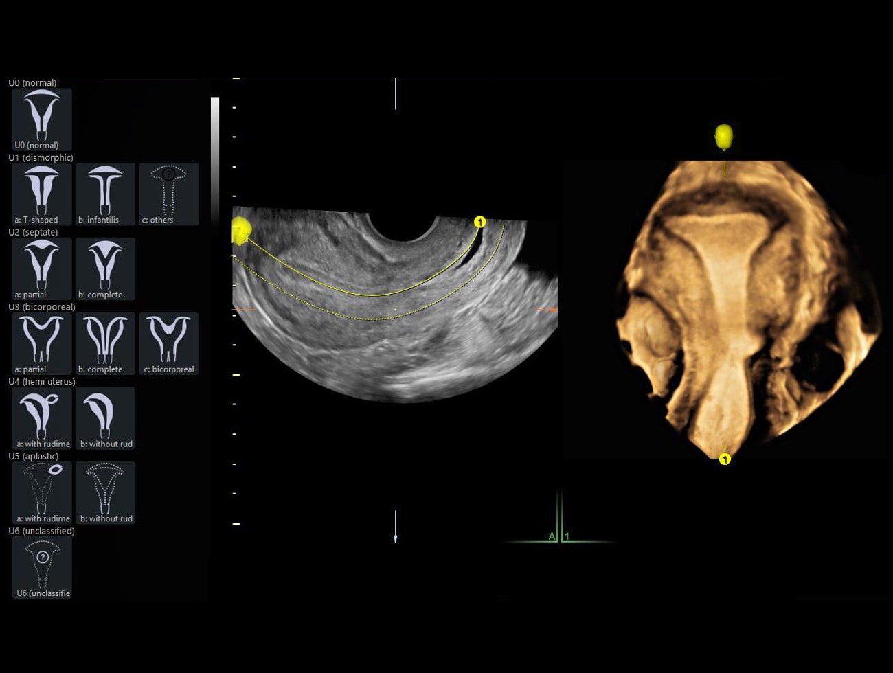 Классификация матки по технологии GE Healthcare voluson