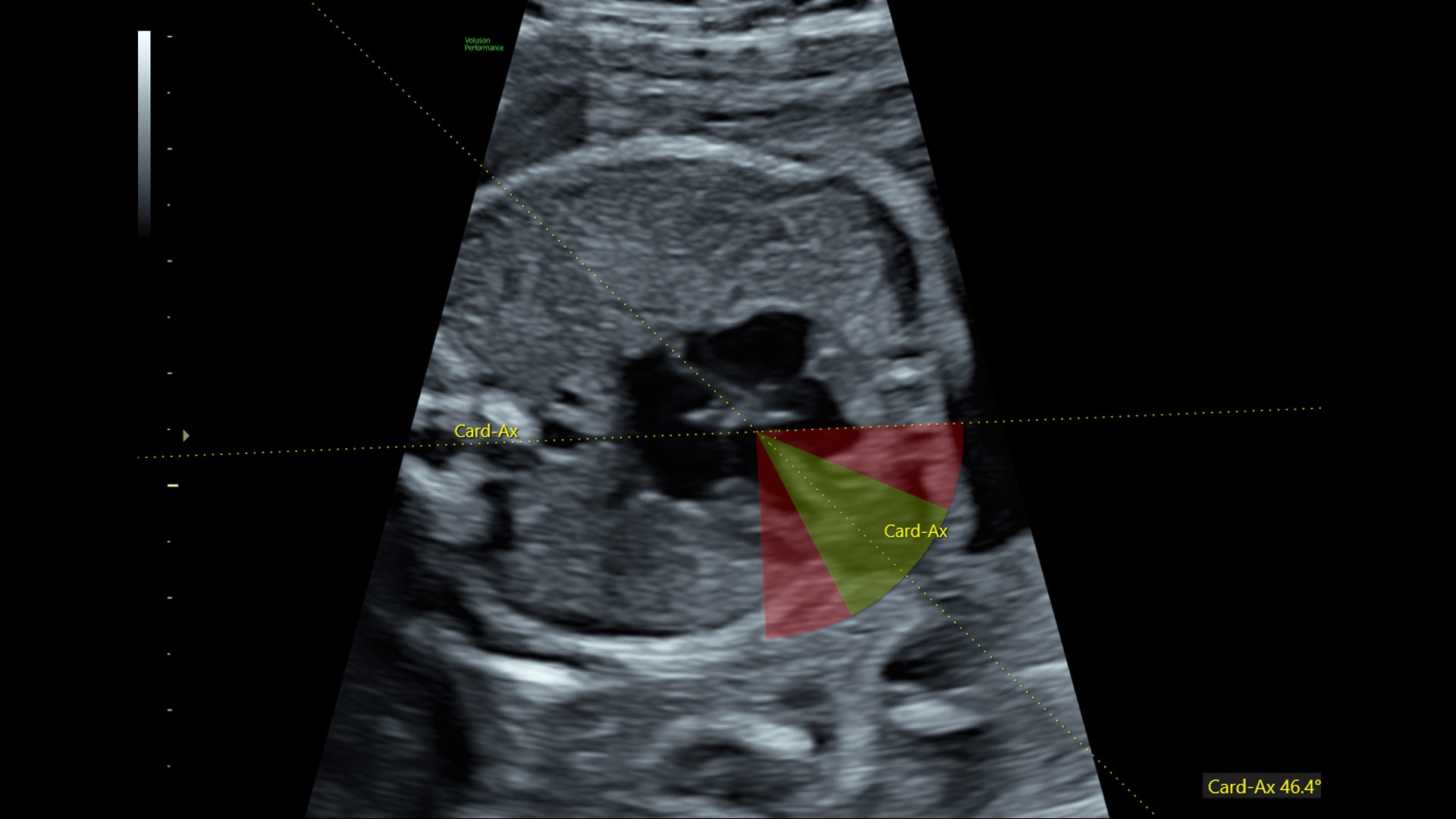 Voluson™ Performance 18 Women's health ultrasound | GE