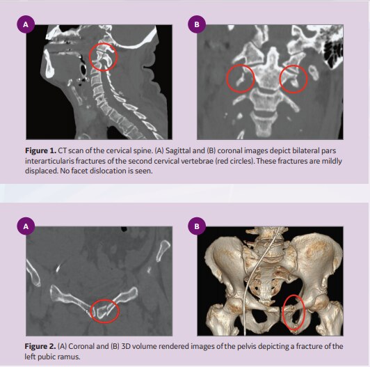 Complex Polytrauma Imaging in the ER with Revolution EVO GE