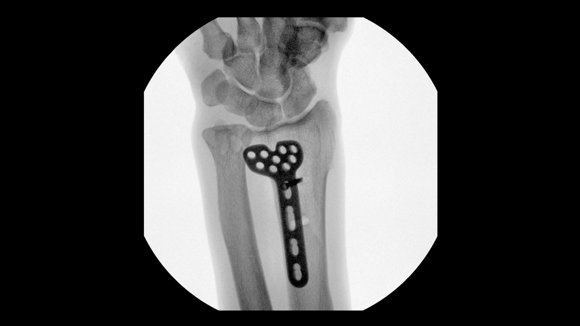 Distal Radius Fixation clinical image