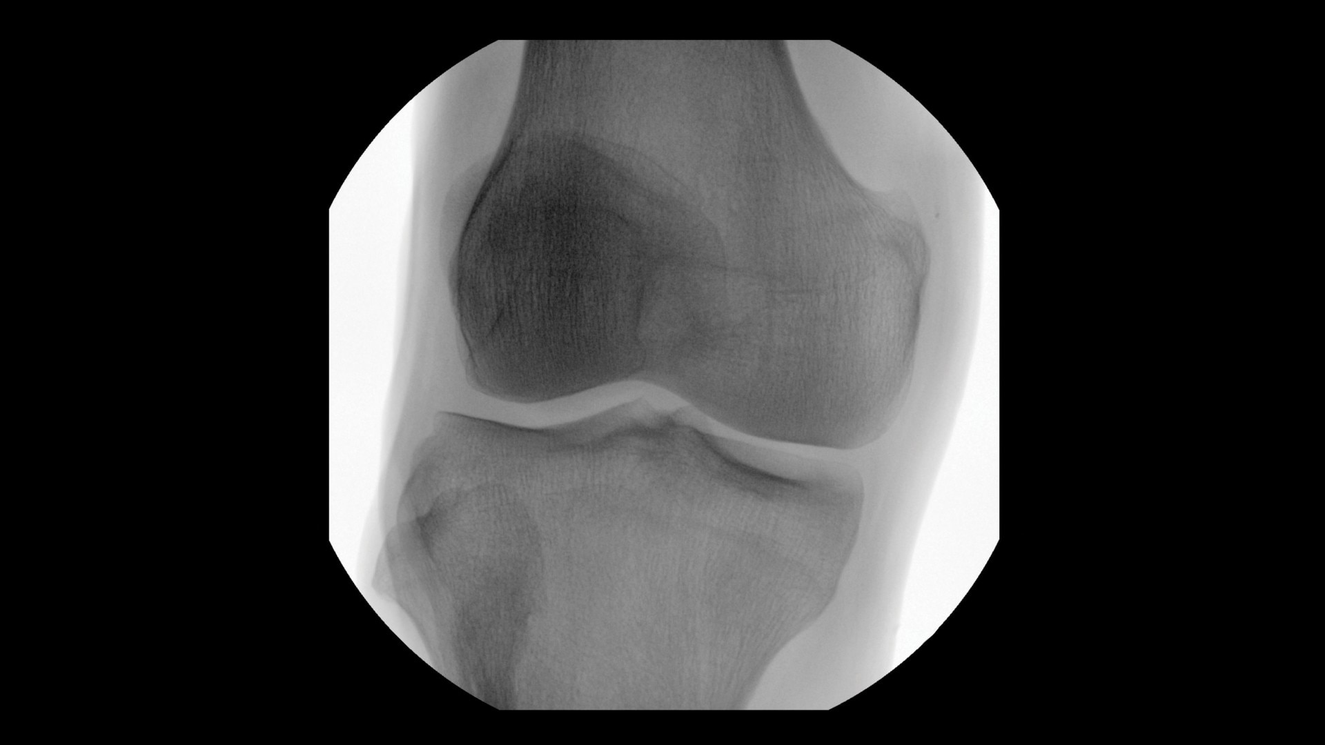 AP Knee clinical image