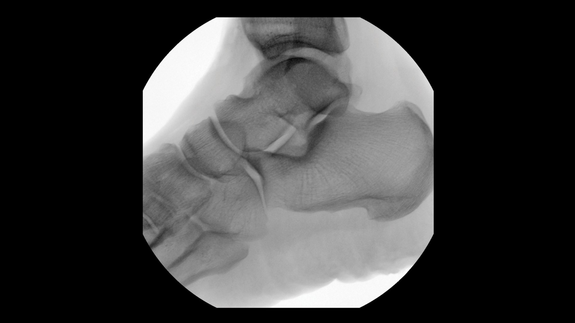 Lateral Foot clinical image