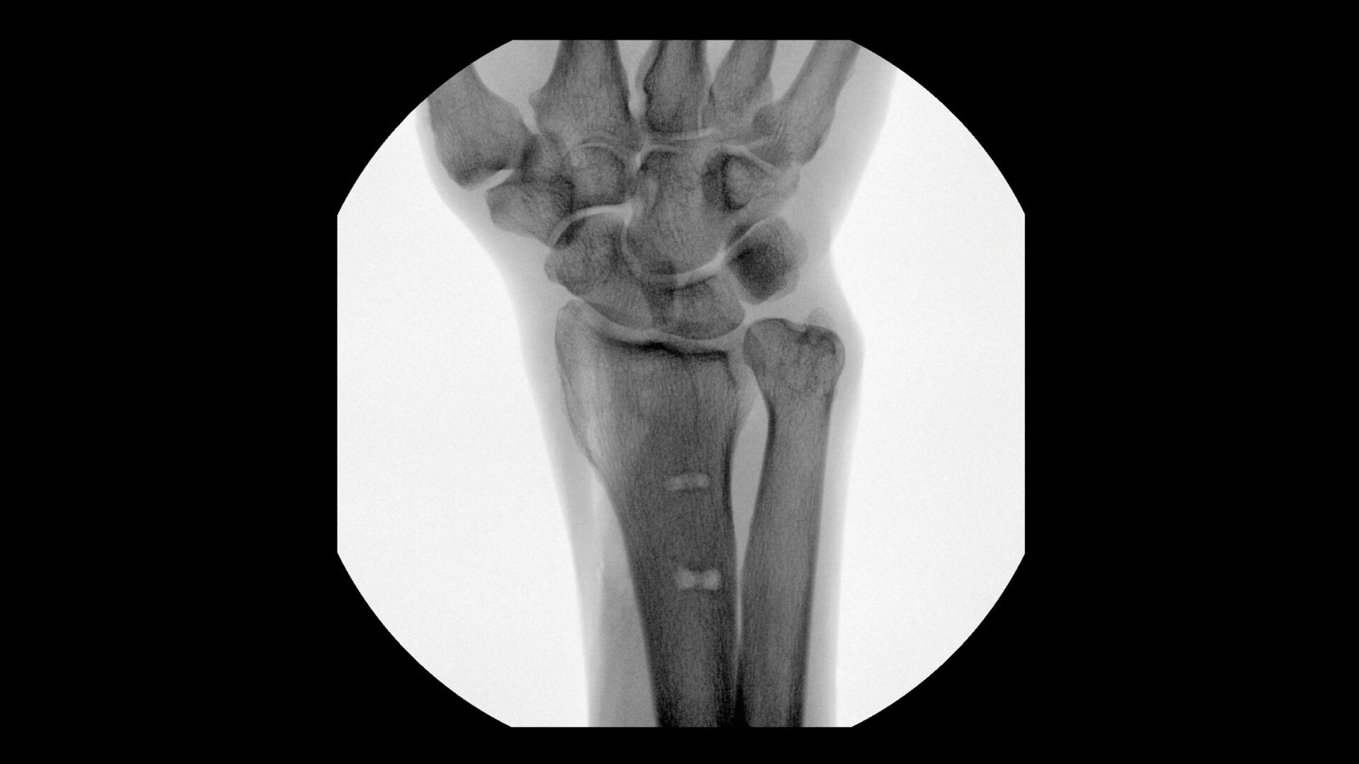 AP Wrist clinical image