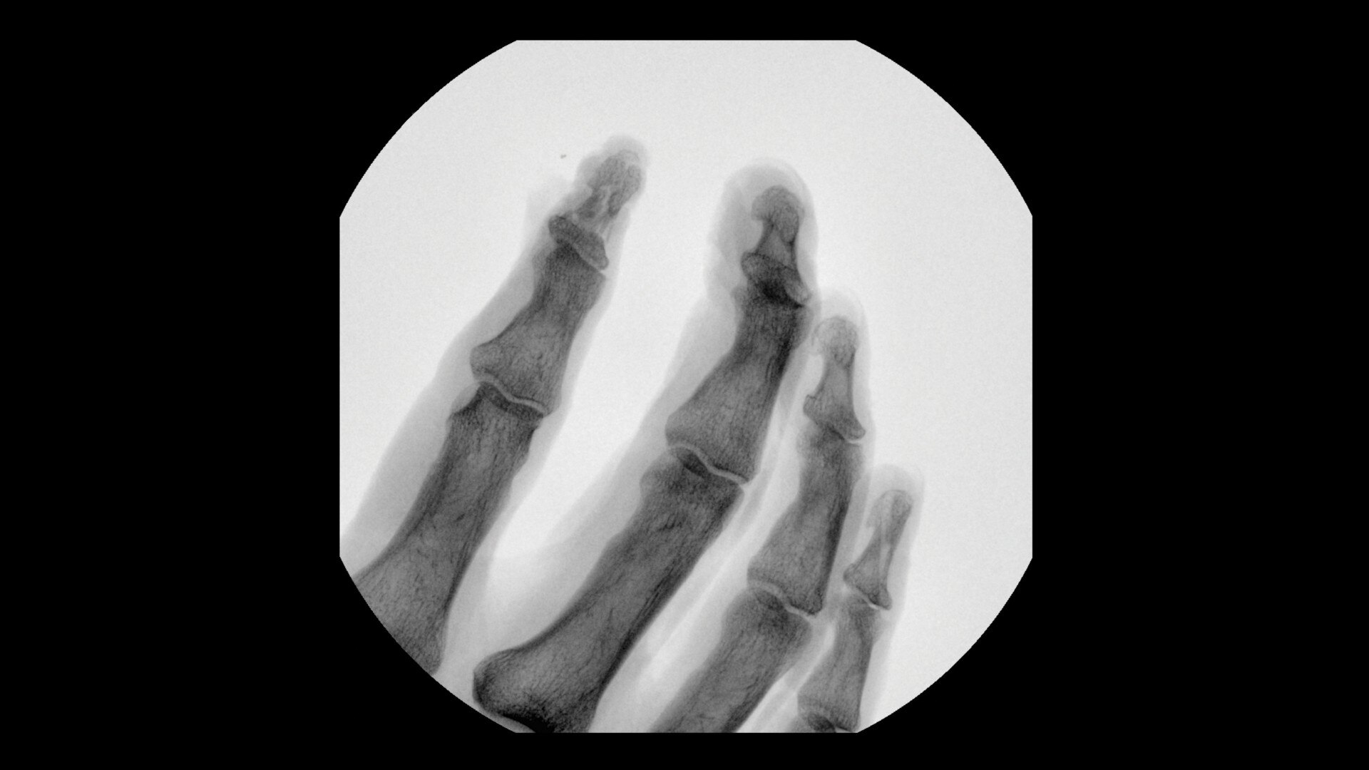 phalanges view clinical image