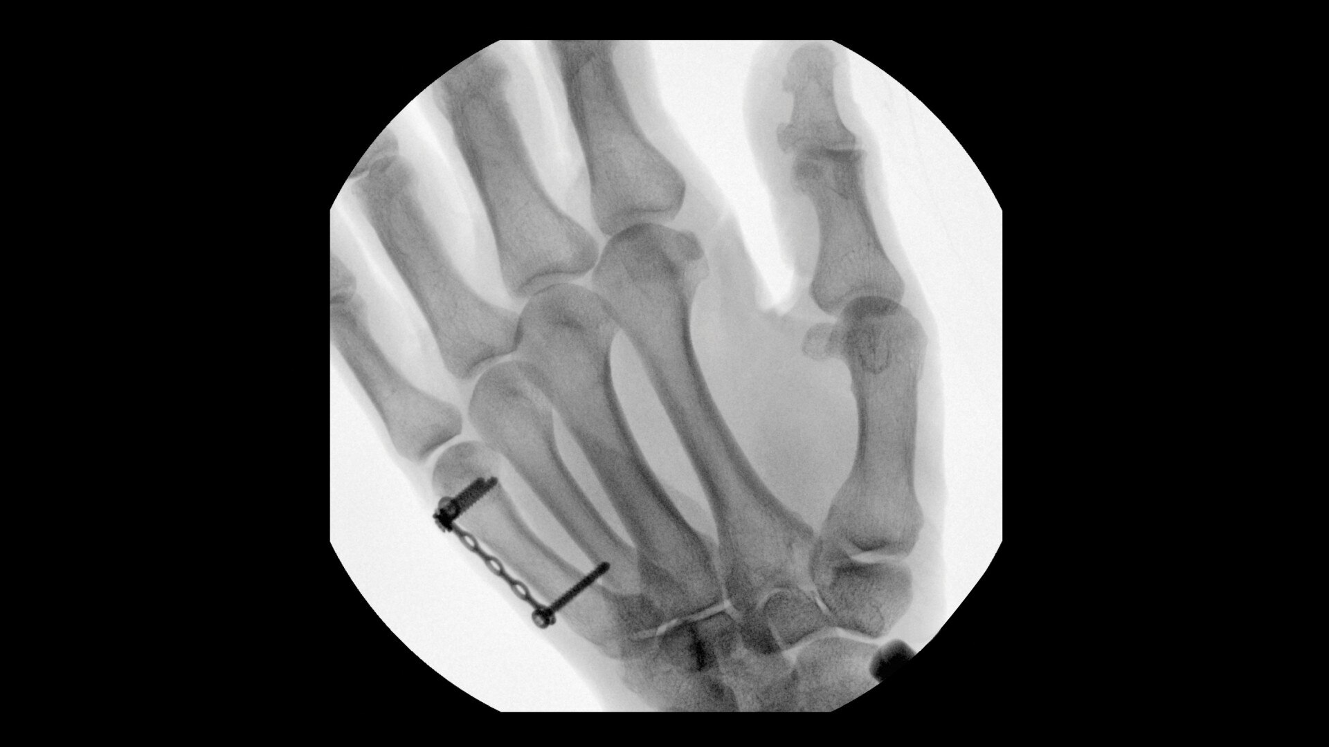 metacarpal fixation clinical image