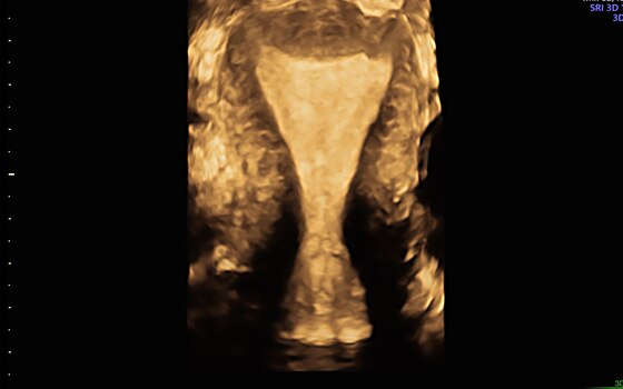 Uterine Trace of Voluson technology