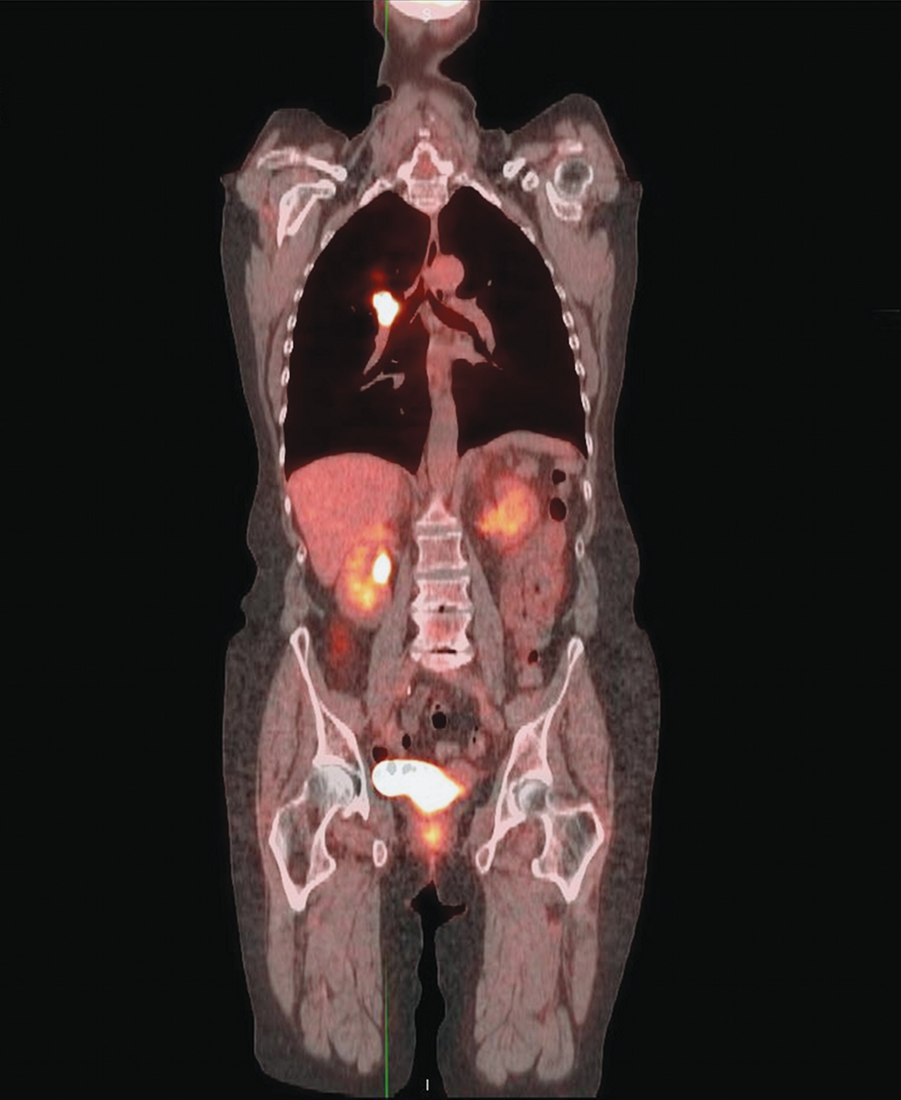Mobile PET/CT from Alliance Helps Akron General Deliver Advanced