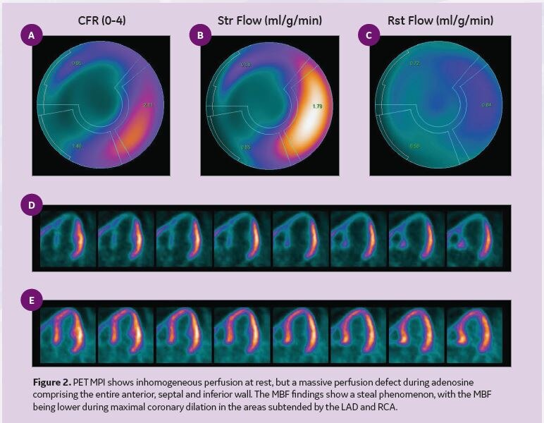 quantitative-myocardial-perfusion-with-pet-ge-healthcare-united-states