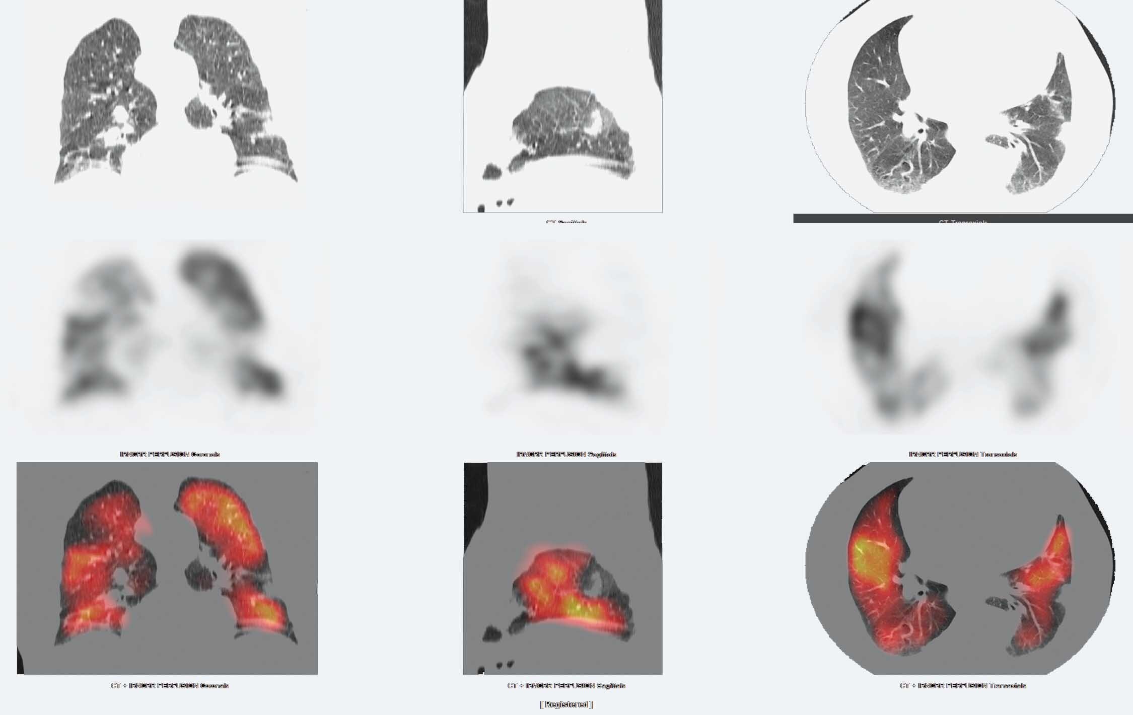 Study Demonstrates Economic Value of SPECT_CT for PE Diagnosis GE