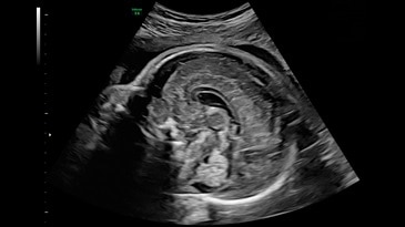 Мозолистое тело и черверез мозжечка на 27 неделе