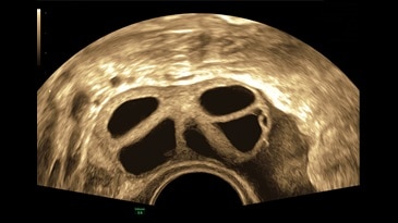 Стимулированные фолликулы яичников