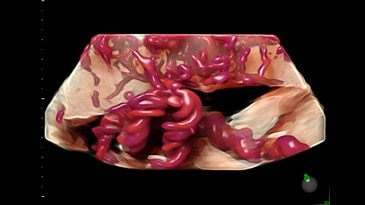 Введение плаценты в пуповину с помощью HDlive Flow