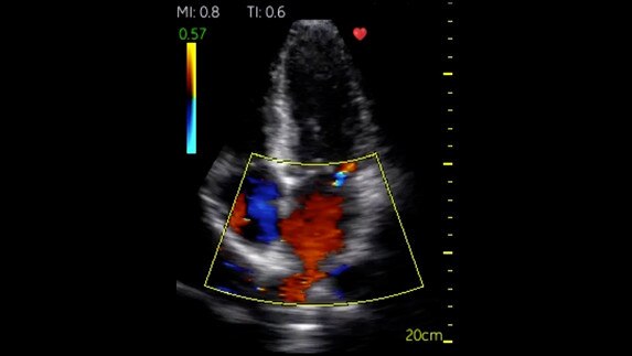 hotspot tours-vscan-cardiac-apical-4-chamber-with-color-flow_jpg