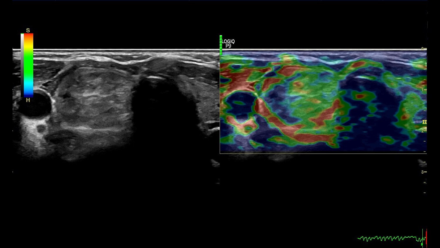 Thyroid elastography with 12L-RS probe