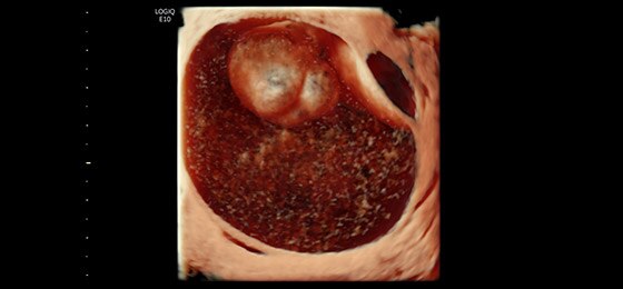 Ovarian Mass 3D Render with HDlive™, RIC5-9-D