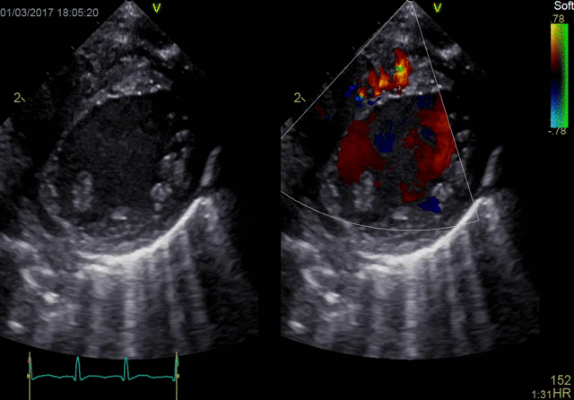 Pediatric Color Flow