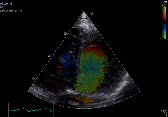 Blood Speckle Imaging (BSI)*