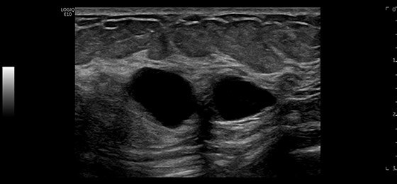 Breast Cysts, ML6-15-D