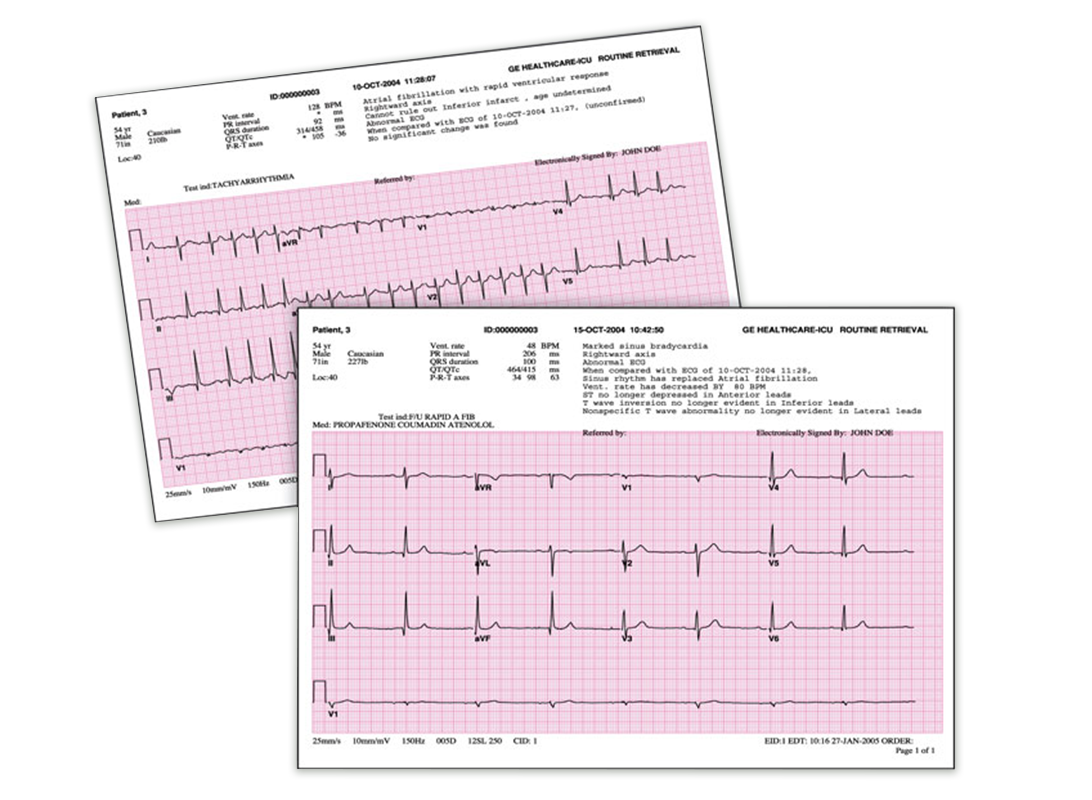 ecg-analysis-programs-ge-healthcare