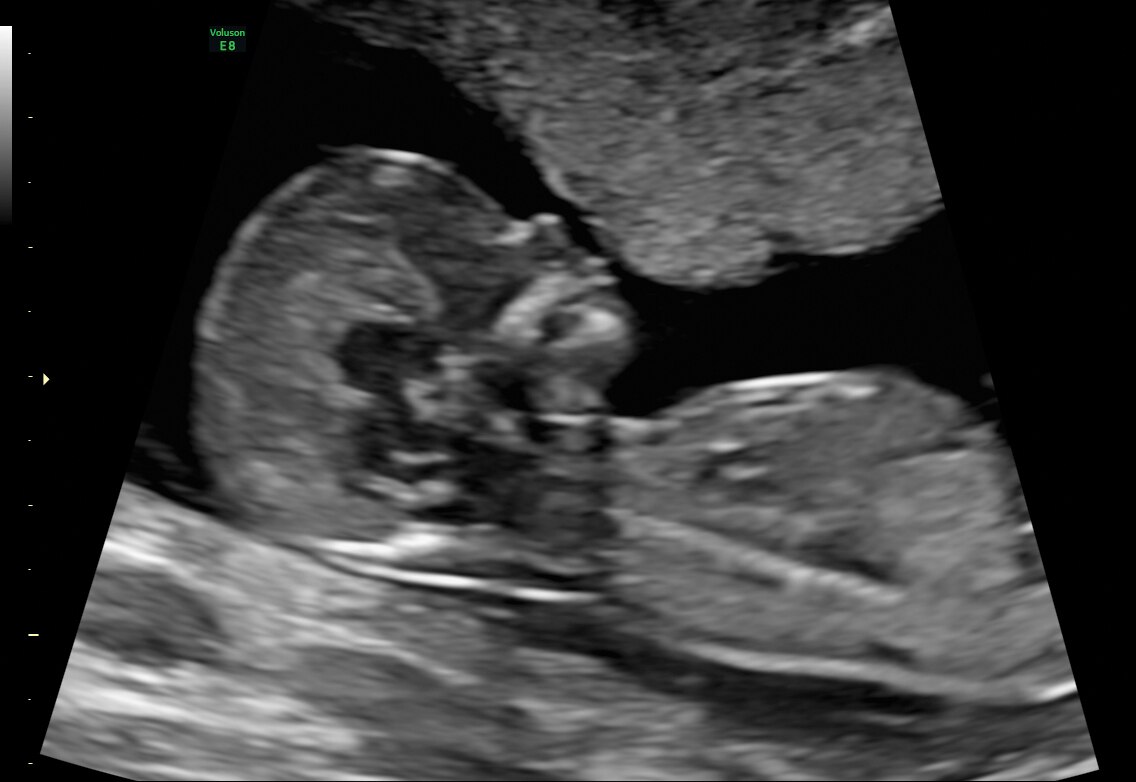 13 week fetal profile