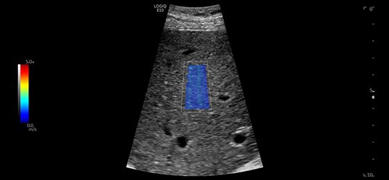 Liver Shear Wave Elastography, C1-6-D