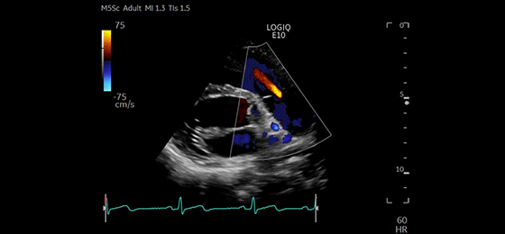 Color Through Pulmonic Valve, M5Sc-D