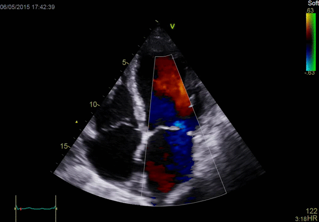 Adult Echo Color Doppler