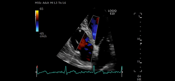Apical 4CH CF Tricuspid Valve, M5Sc-D 