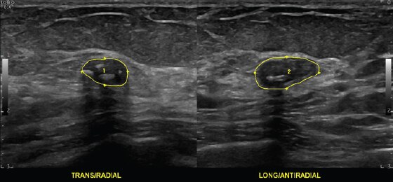 Benign Breast Mass with Multiple Calcifications, ML6-15-D