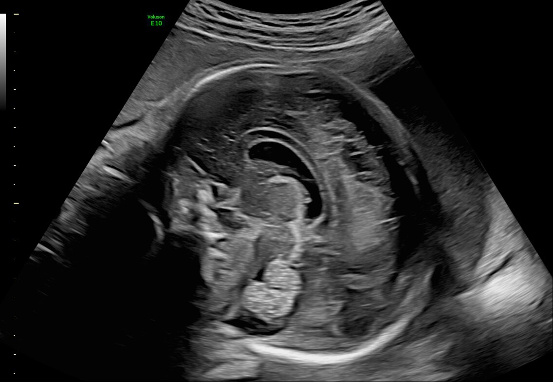 Fetal brain with C2-9 probe and HDRes