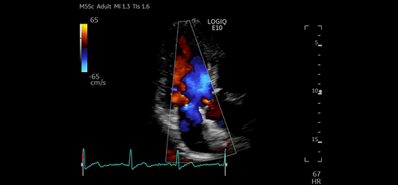 Alax CF Mitral and Aortic Valves, M5Sc-D