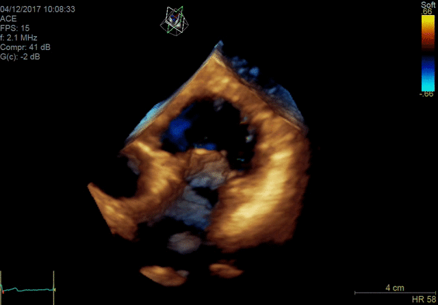 4D color imaging with the 4Vc-D probe