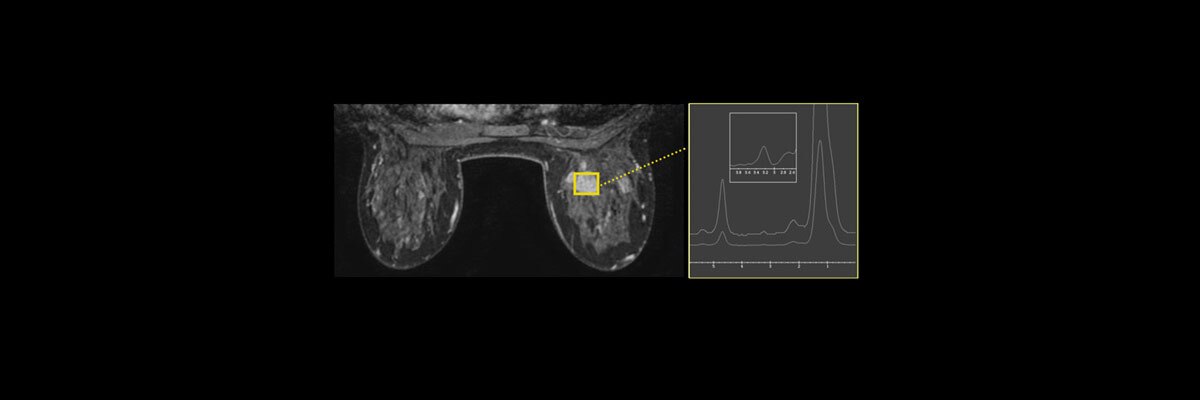 product-product-categories-magnetic-resonance-imaging-breast-imaging-brease-brease_spotlight.jpg
