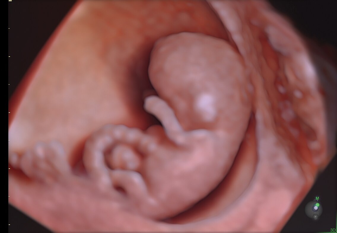 10 week fetus rendered with HDlive Studio