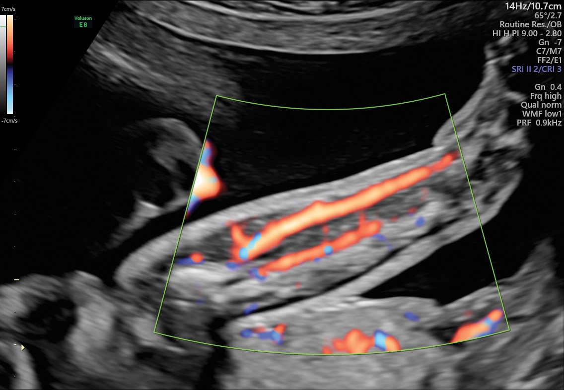 HD-Flow™ in 26 week fetal arm