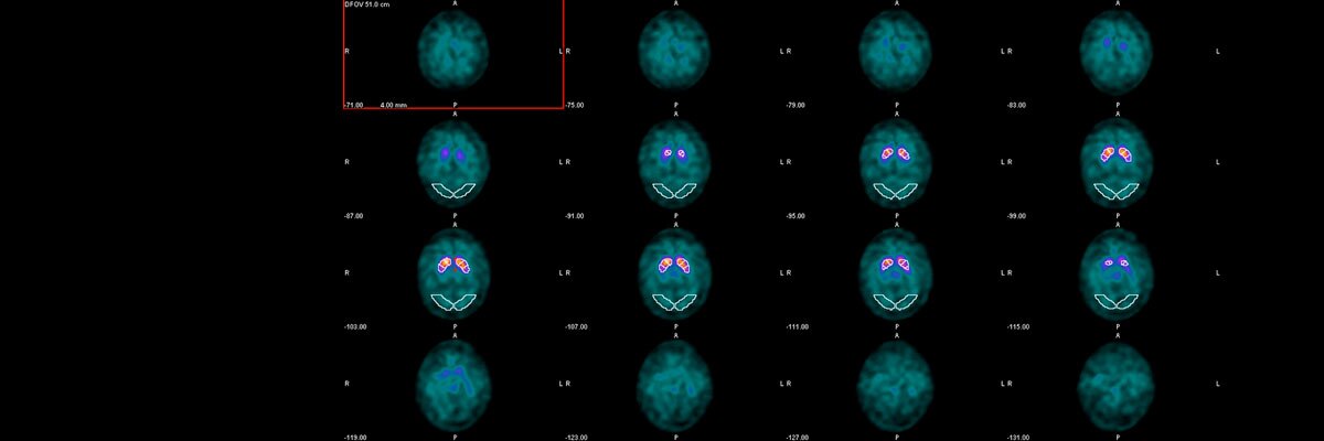 product-product-categories-nuclear-imaging-agents-datquant-website with roi r1.jpg