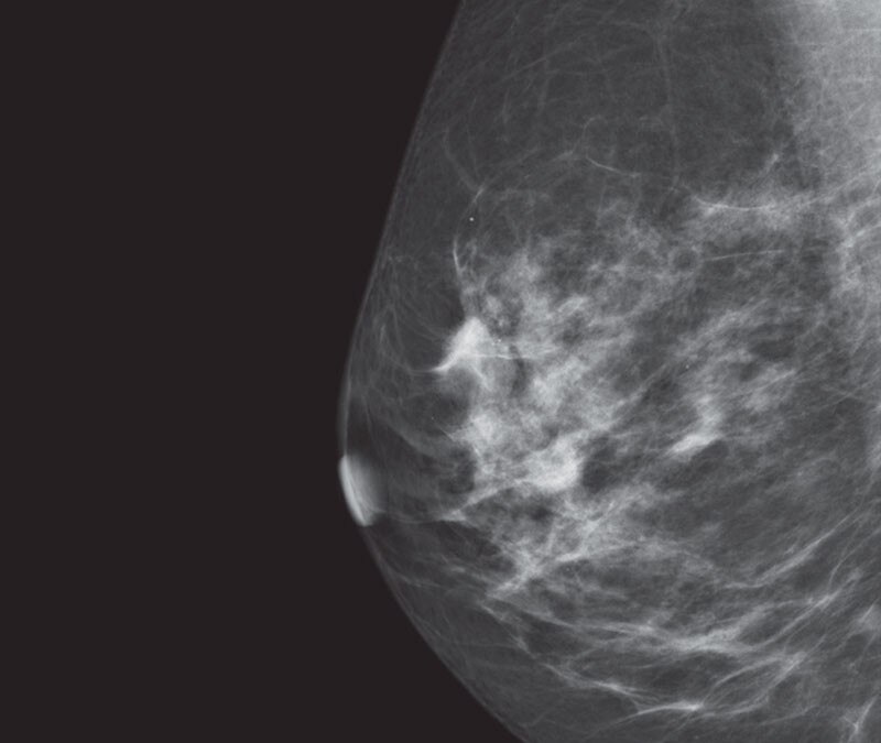 3d tomosynthesis vs mammography image