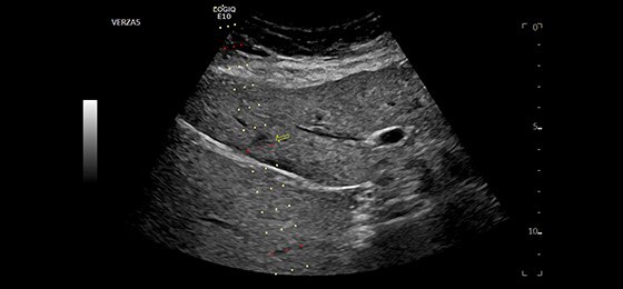 Liver Biopsy with five-angle Verza**  needle guide