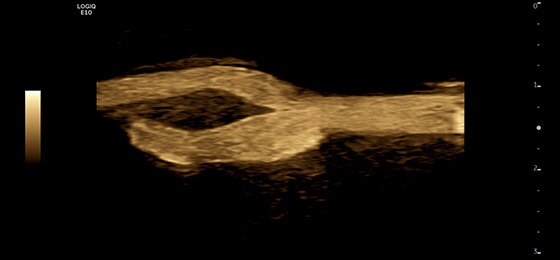 Carotid B-Flow™, L2-9-D