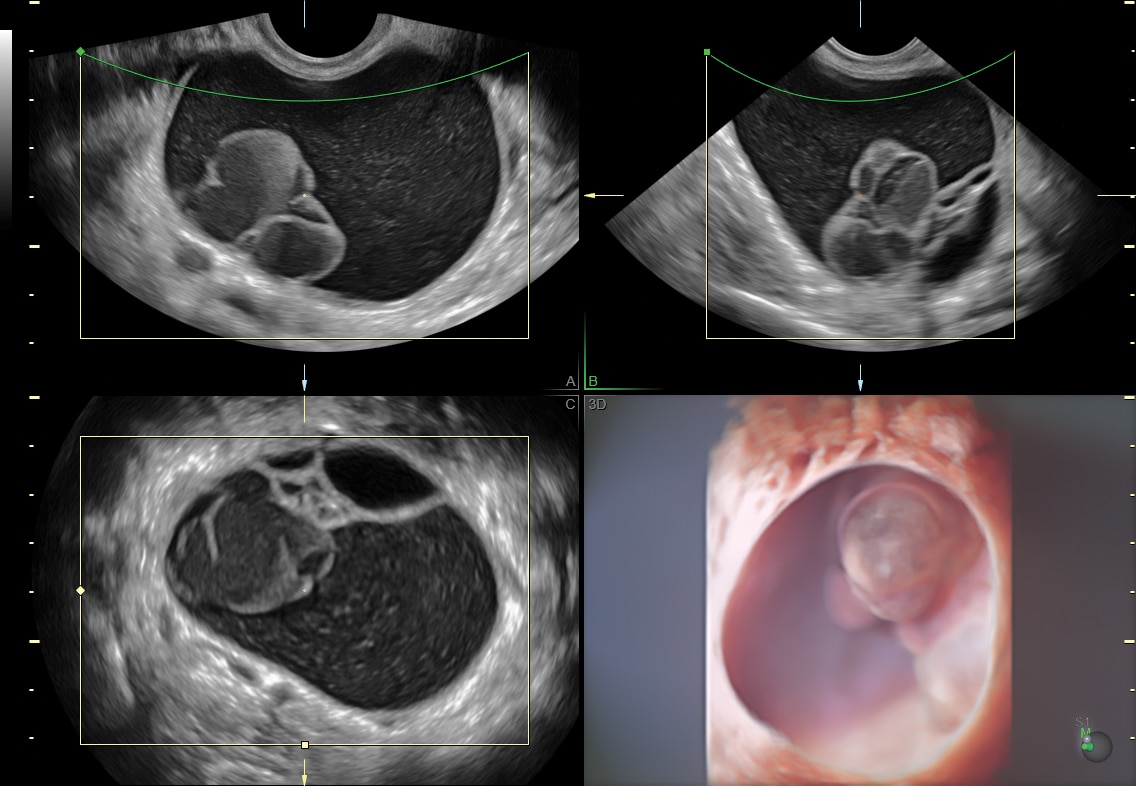 Ovarian cystic mass rendered with HDlive Studio