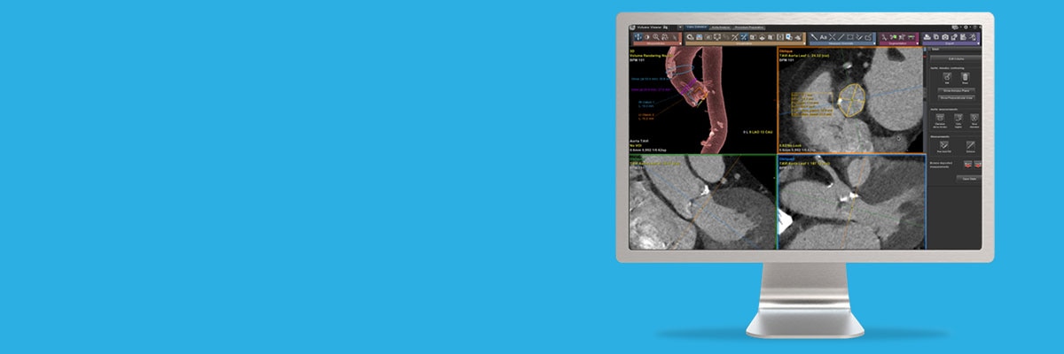 not-clone-advanced-visualization-applications-tavi analysis-aw-tavi-analysis-spotlight.jpg