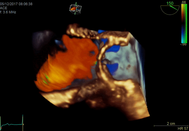 4D TEE color imaging with Vmax