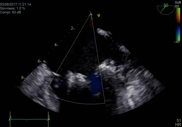 Blood Speckle Imaging**