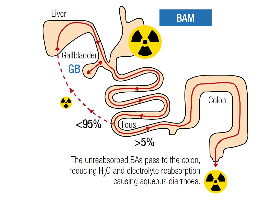 patients with BAM diarrhea patients with BAM diarrhea