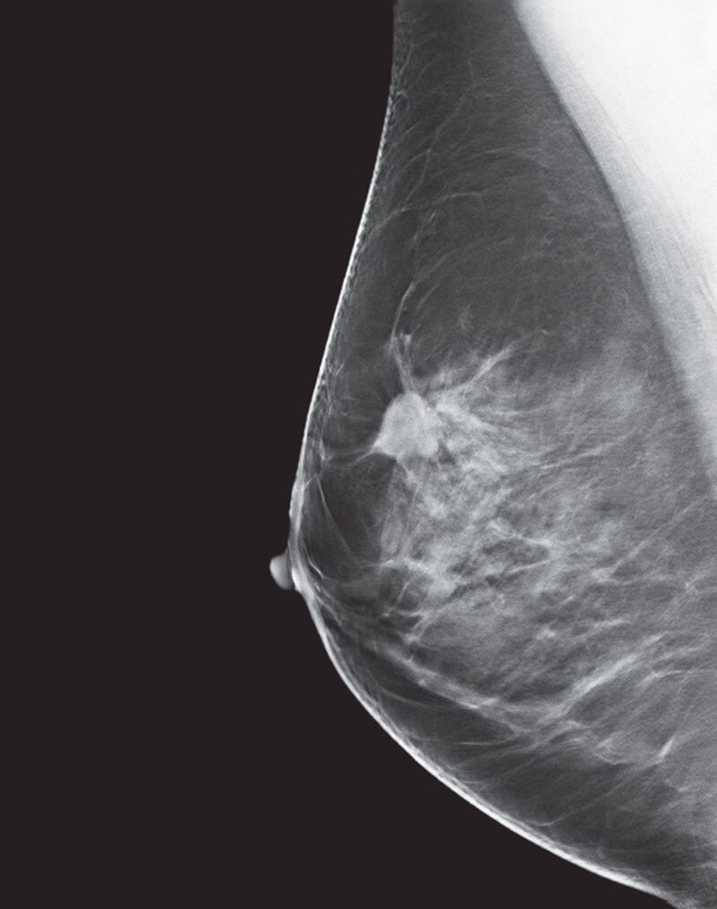 3d mammogram call back reasons image