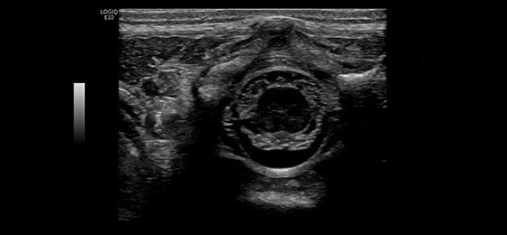Neonatal Spine, L8-18i-D