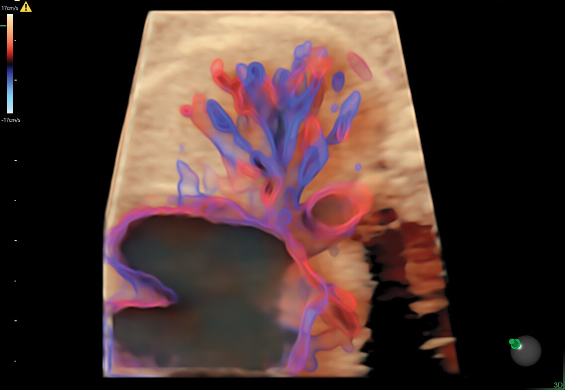 Fetal lung perfusion - STIC with HDlive Flow Silhouette