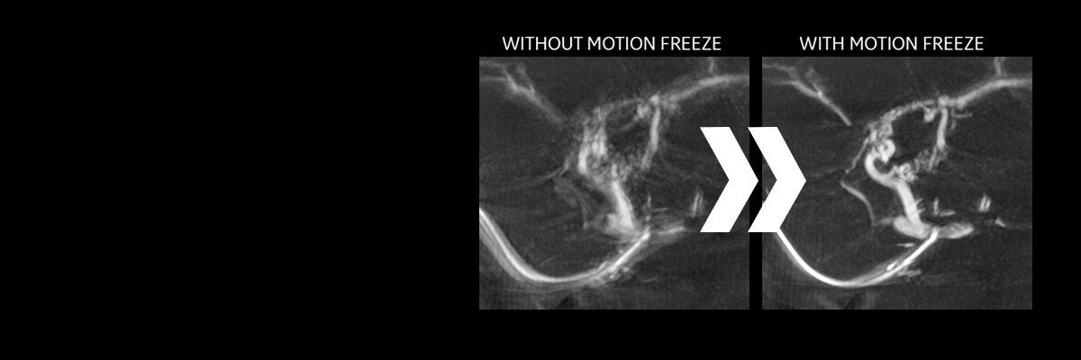 Motion Freeze