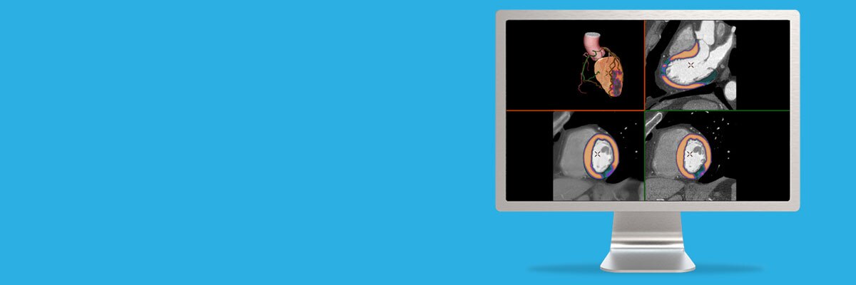 advanced-visualization-applications-cardiq-xpress-reveal-aw-cardiq-xpress-reveal-spotlight1