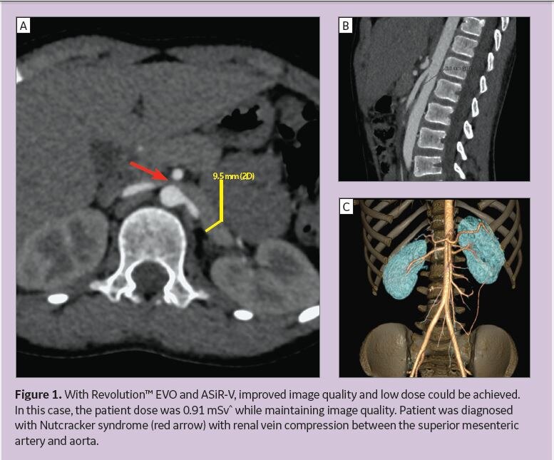 Lowdose Pediatric CT Imaging Helps Detect Nutcracker Syndrome GE